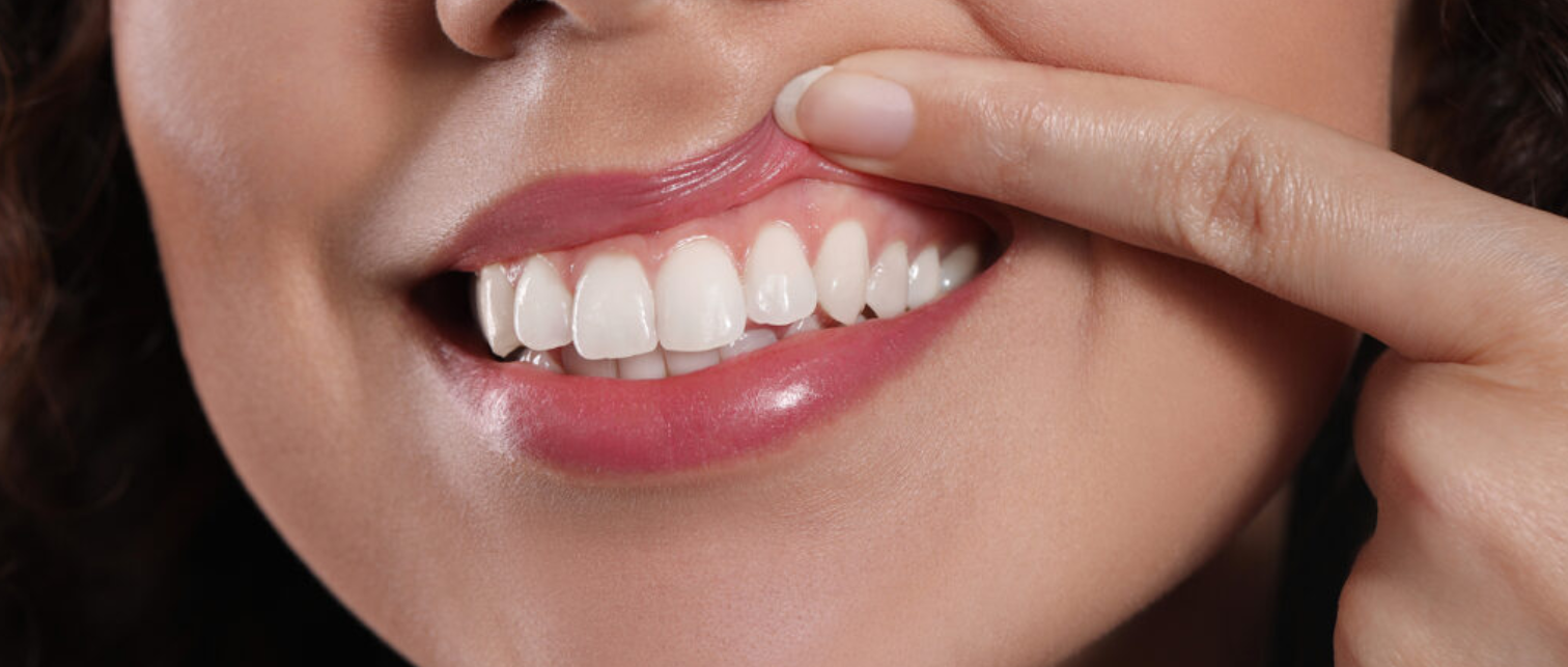 Diş Eti Hastalığı Hakkında Merak Edilenler