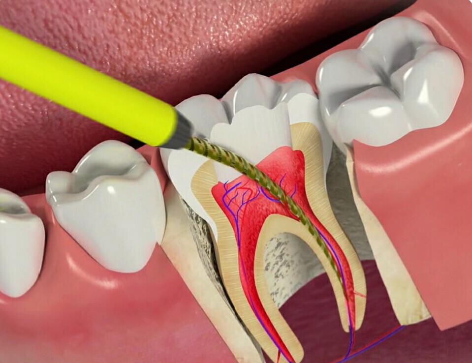 Kanal Tedavisine Neden İhtiyaç Duyulur?