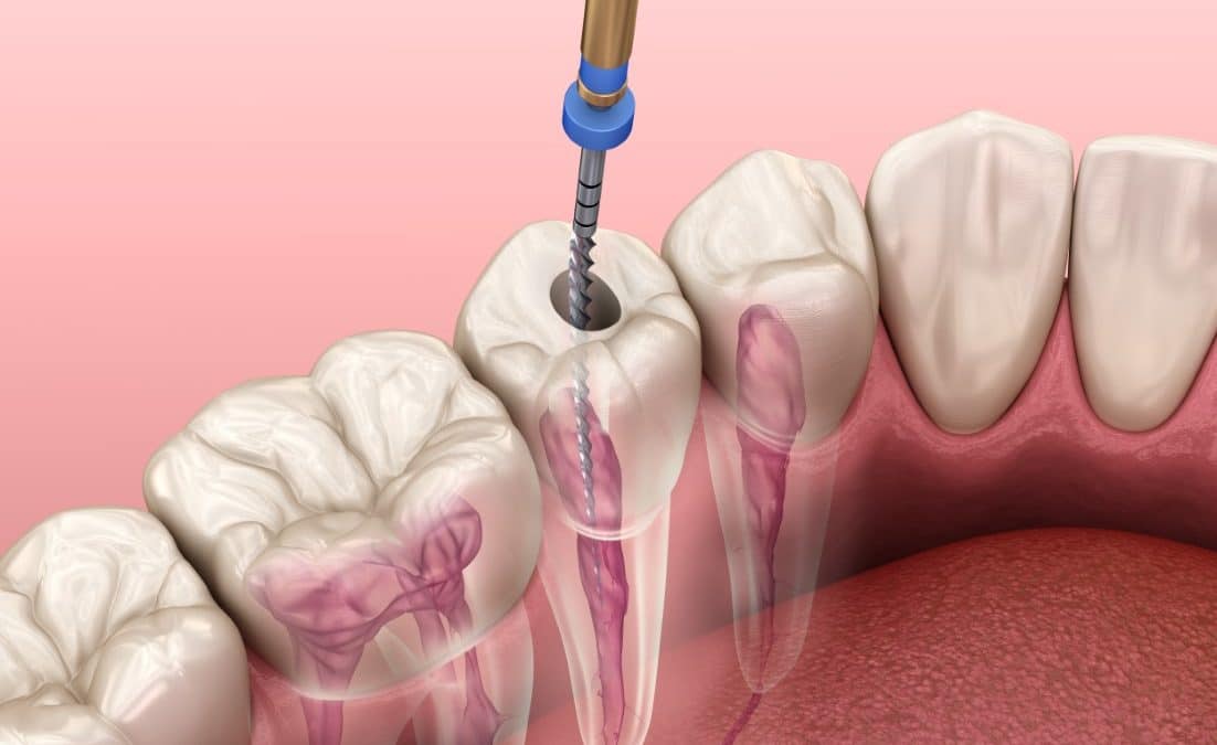 Kanal Tedavisinde Sıkça Sorulan 4 Soru