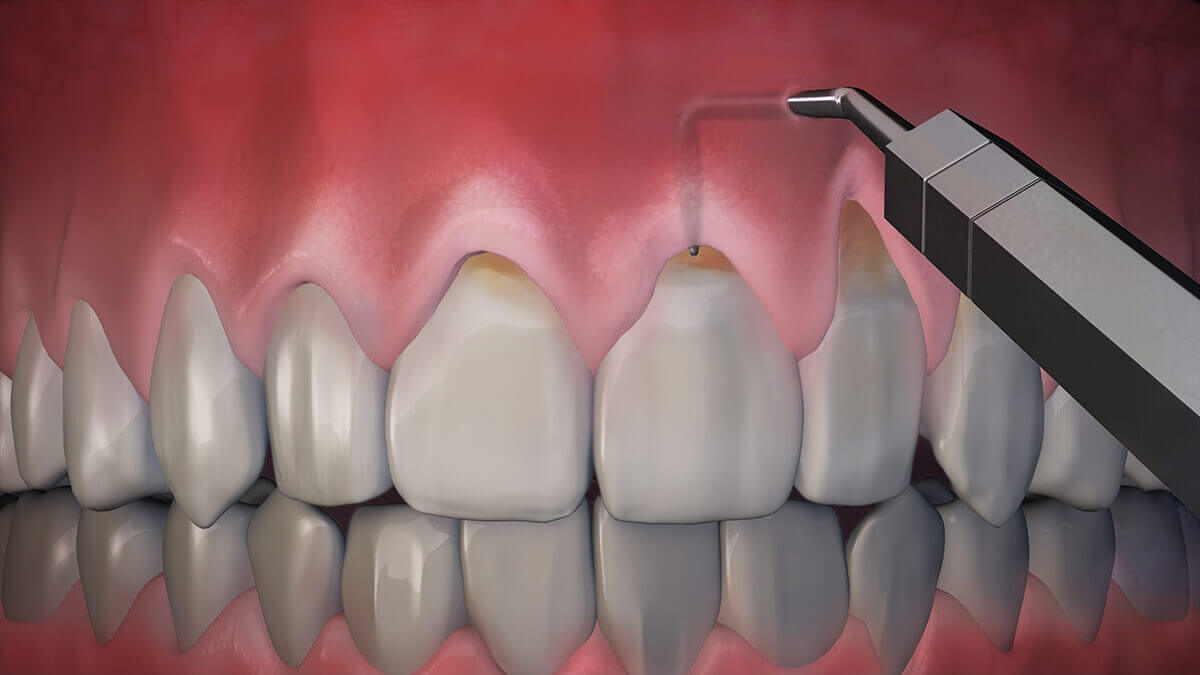 Periodontal Hastalıkların Çeşitleri Nelerdir?