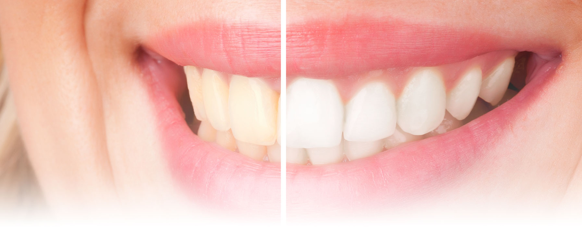 Evde Diş Beyazlatmanın Zararları