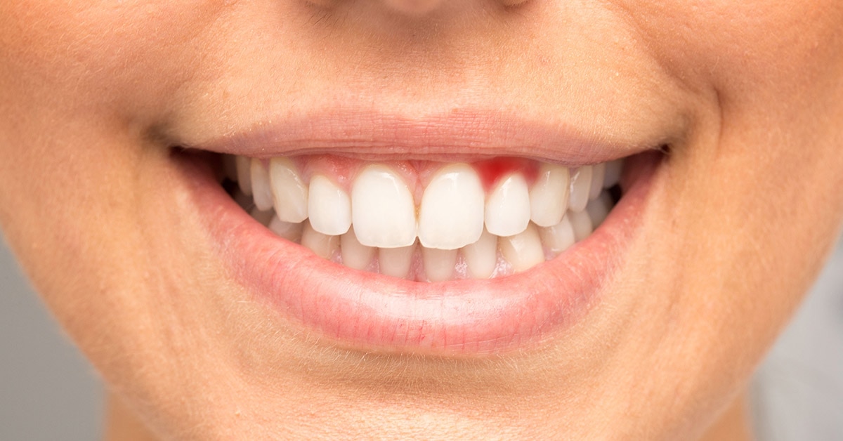 Diş Eti Kanamasının Nedenleri